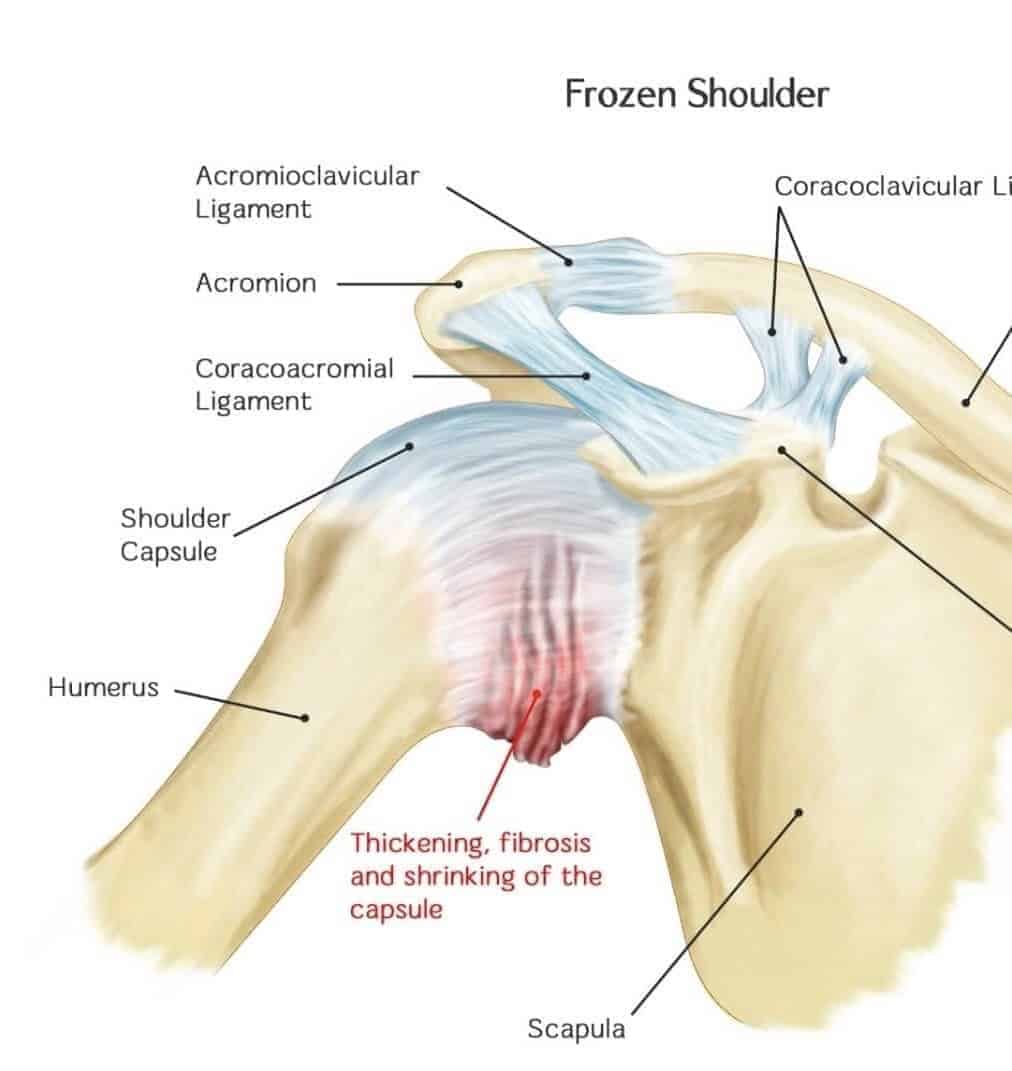 Anatomy image of frozen shoulder
